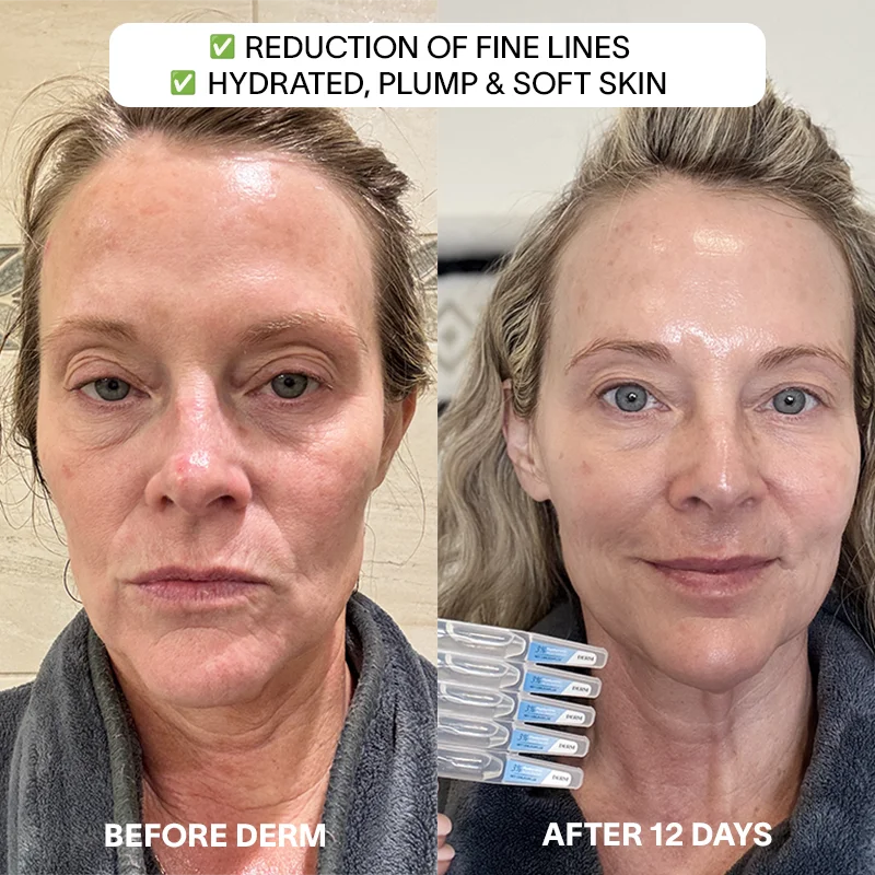 6x Derm 3% Hyaluronic Acid Serum - Image 4