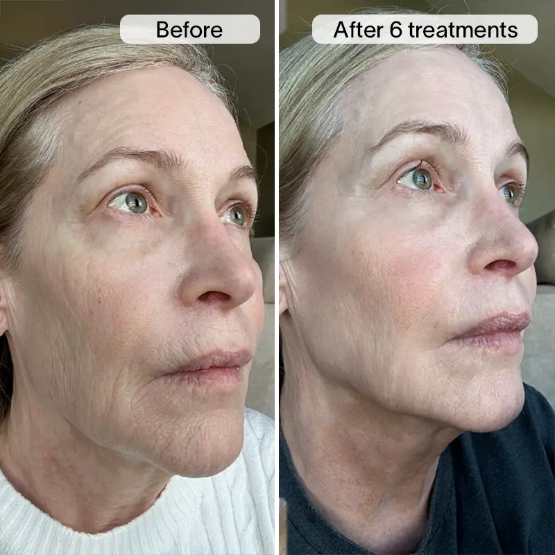 PDRN Micro Infusion Treatment - Image 11