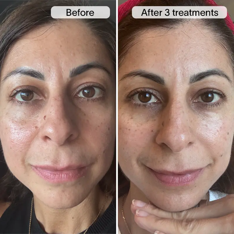 PDRN Micro Infusion Treatment - Image 12