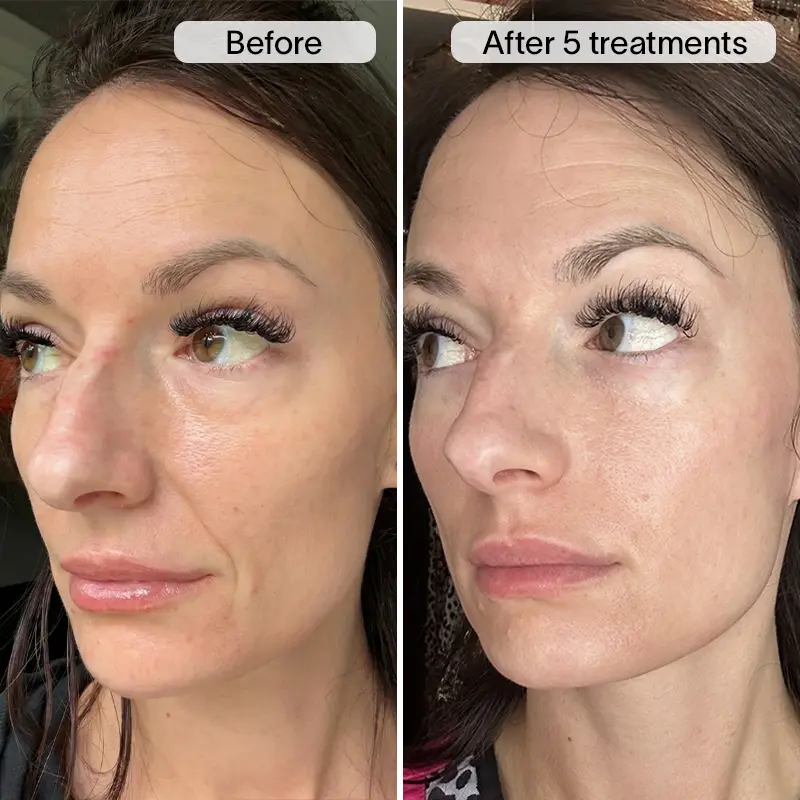 PDRN Micro Infusion Treatment - Image 4